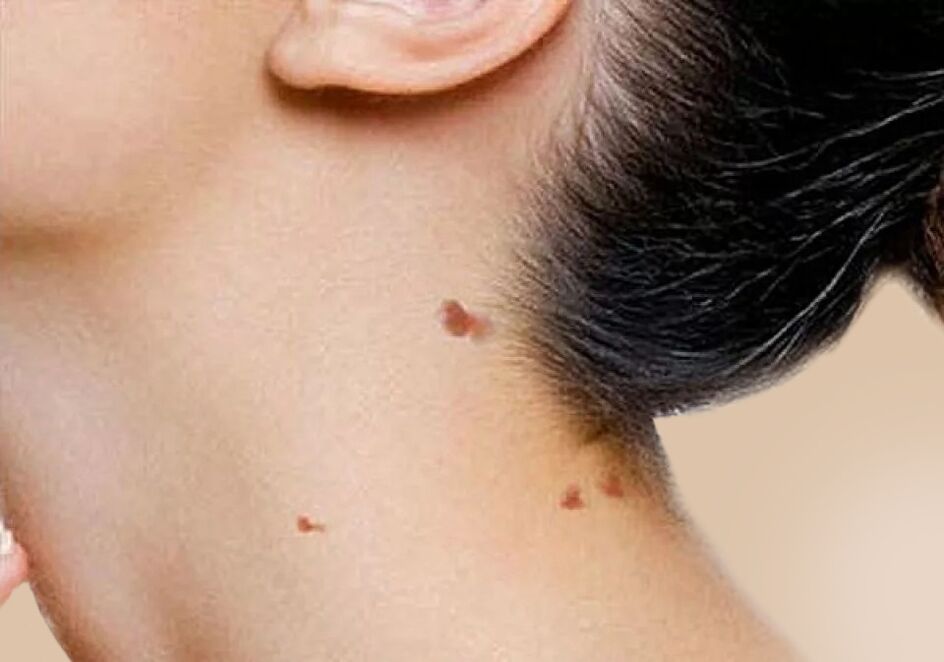 O aparecimento de papilomas no pescoço após a ativação do HPV no corpo