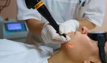 Um procedimento eficaz para remover papiloma no rosto com um laser