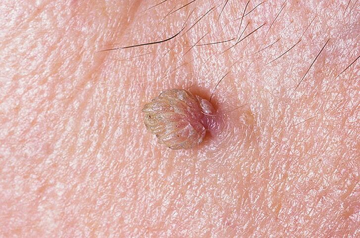 Uma verruga na pele que pode ser removida de várias maneiras