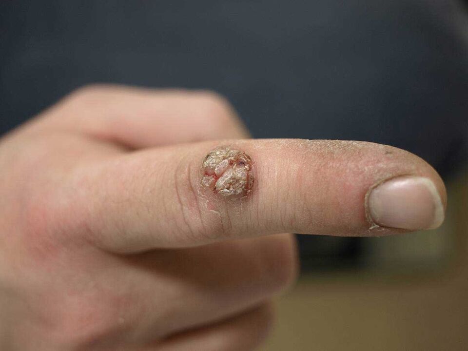 Verruga grande em um dedo que requer remoção