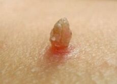 Papilloma nítido