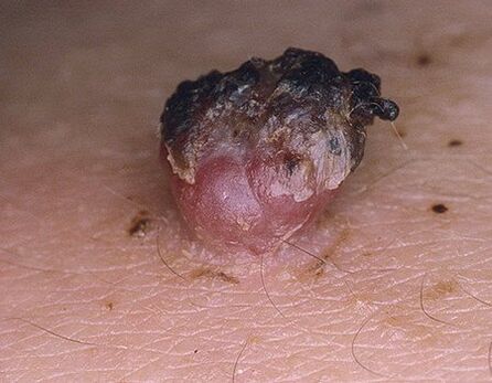Papiloma enegrecido