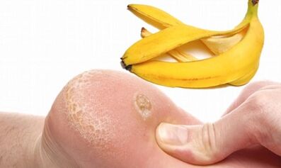 Casca de banana para o tratamento de uma verruga plantar