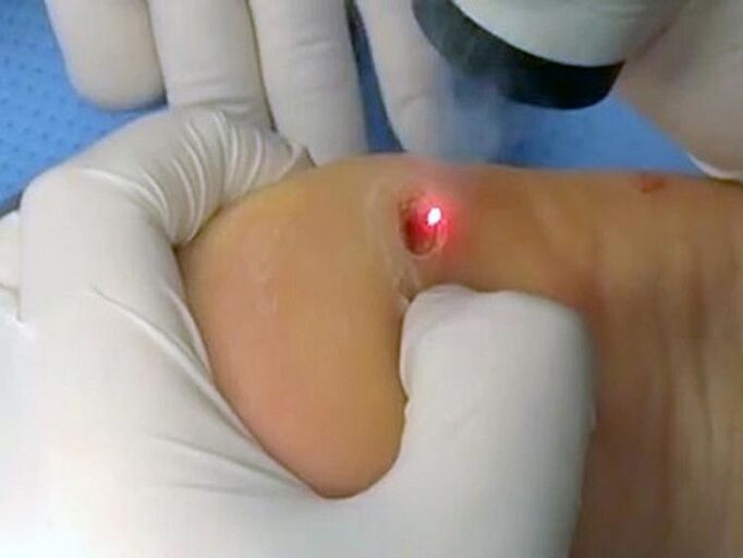 tratamento a laser para verrugas