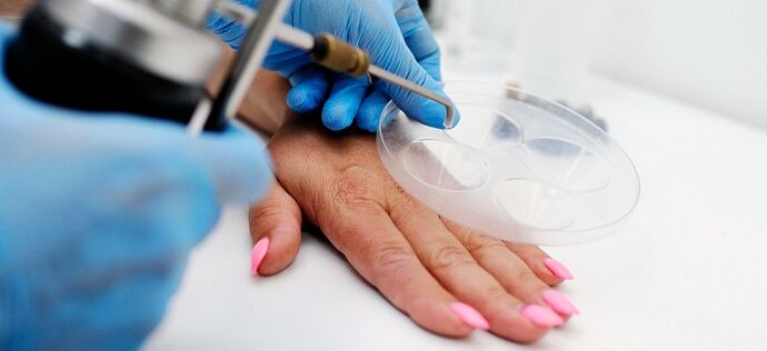 verrugas no corpo humano