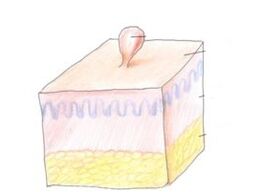 como se livrar do papiloma no corpo