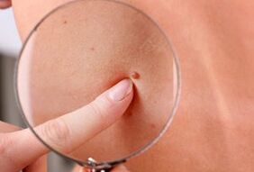 razões para o aparecimento de papilomas no corpo humano