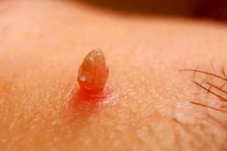 verrugas genitais no corpo