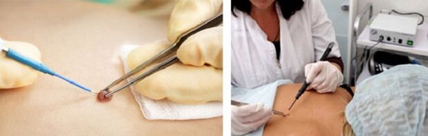 eletrocoagulação como forma de remover papilomas