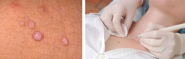 remoção profissional de papilomas no corpo