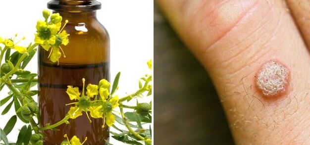 tratamento de verrugas com celidônia farmacêutica
