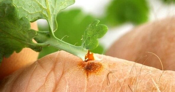 tratamento de verrugas com celidônia