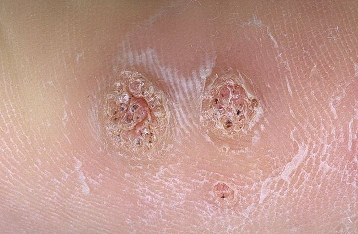 verrugas no corpo