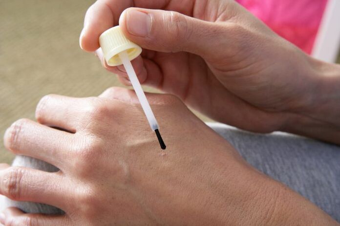 cauterização de verrugas com suco de celidônia