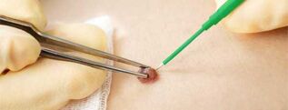 Eletrocoagulação - um método para remover uma verruga